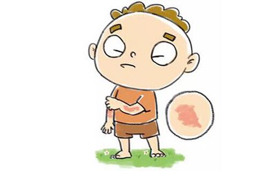 高壓氧 VS 銀屑病